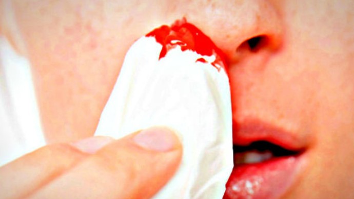 zašto je krvarenje iz nosa za hipertenziju